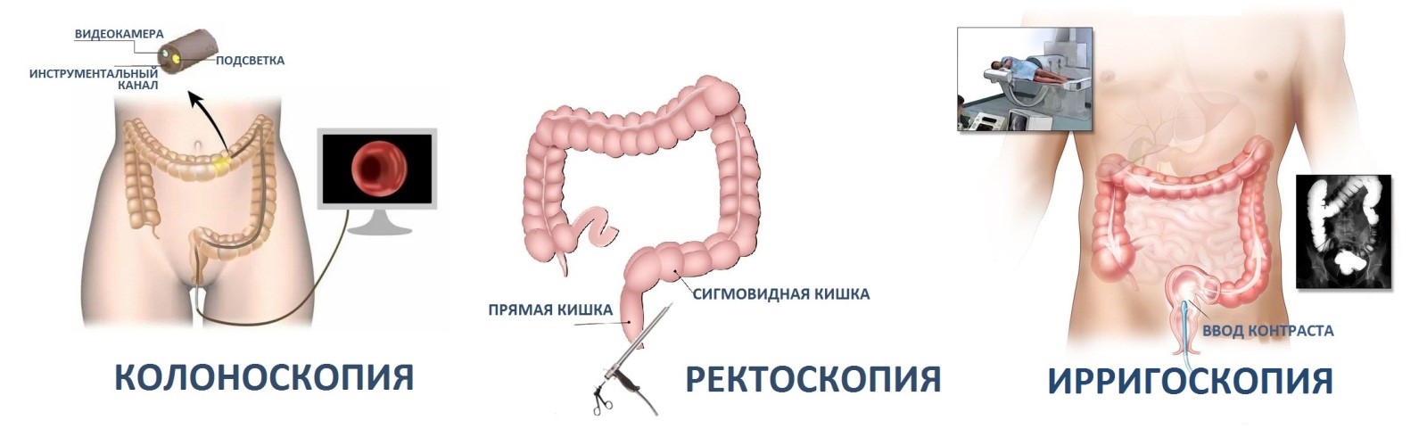 Колоректальный рак — профилактика, стадии, симптомы - Hadassah Medical Moscow