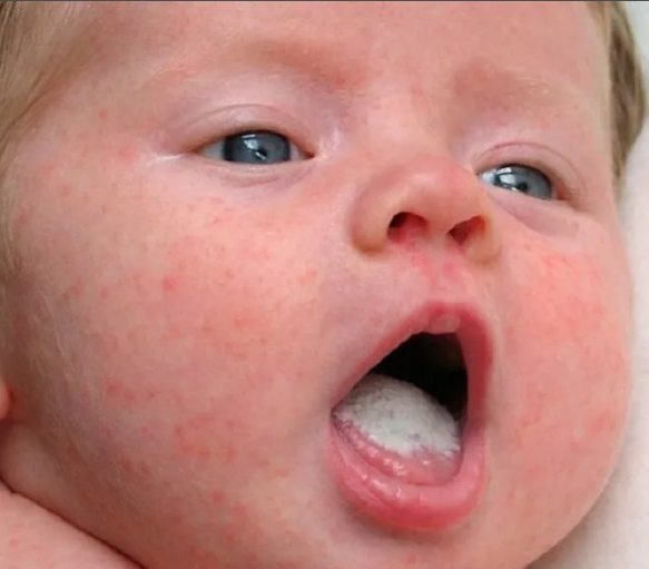 Виды стоматита у ребенка: симптомы, описание, рекомендации по лечению